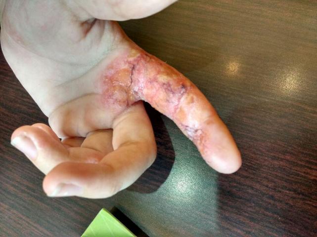 IMAGEN DE LA MANO DEL NIÑO CON DERMATITIS DE CONTACTO. GENTILEZA DE LA FAMILIA